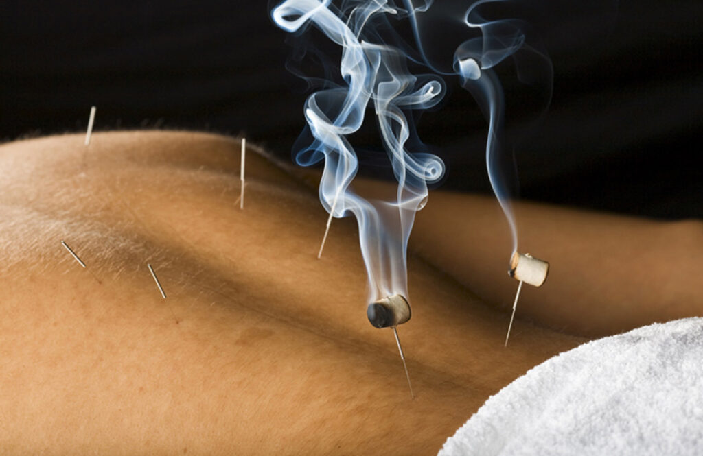 Acupuncture services in Northern Virginia