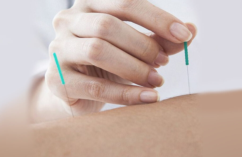 acupuncture dry needling